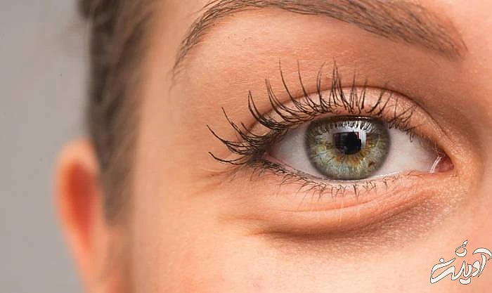 پف چشم ها از مضرات بی تحرکی تاثیرات کم تحرکی